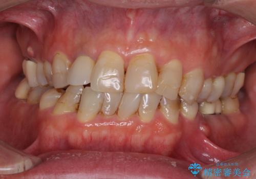 歯列不正と歯周病　総合歯科治療による全顎治療の症例 治療前