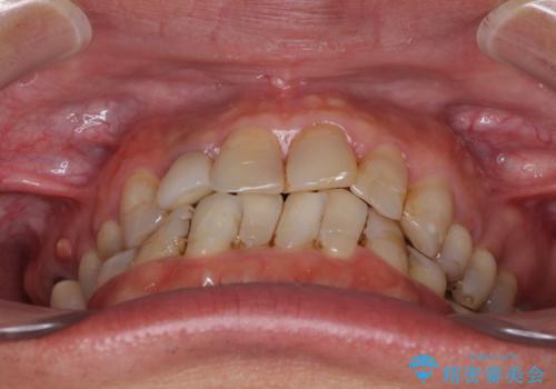 歯列不正と歯周病 総合歯科治療による全顎治療の治療前