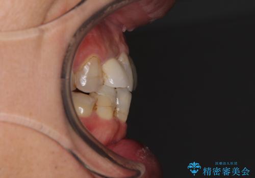 歯列不正と歯周病 総合歯科治療による全顎治療の治療前