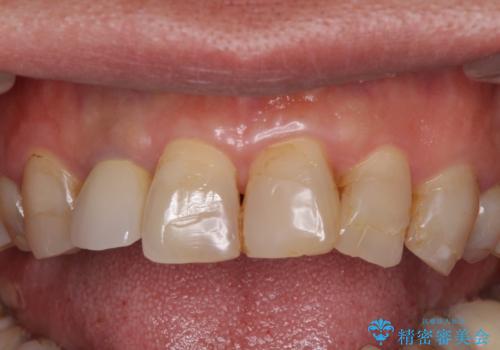 歯列不正と歯周病 総合歯科治療による全顎治療の治療前
