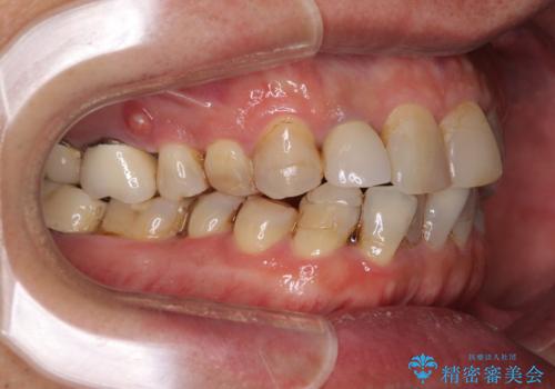 歯列不正と歯周病 総合歯科治療による全顎治療の治療前