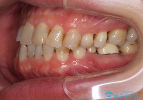 歯列不正と歯周病 総合歯科治療による全顎治療の治療前