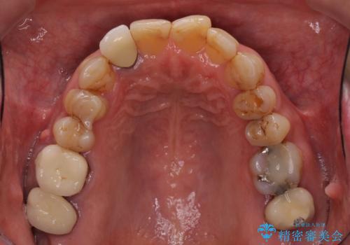 歯列不正と歯周病 総合歯科治療による全顎治療の治療前