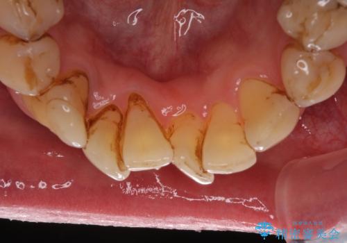 歯列不正と歯周病 総合歯科治療による全顎治療の治療前