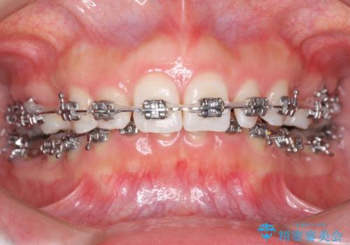 出っ歯を治したい 過蓋咬合の治療中