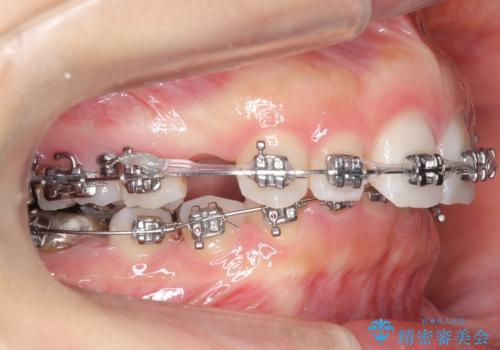 出っ歯を治したい 過蓋咬合の治療中