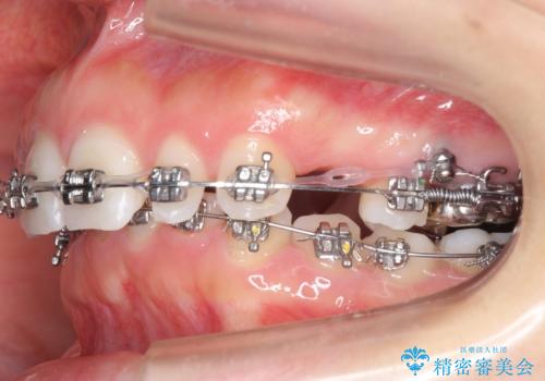 出っ歯を治したい 過蓋咬合の治療中