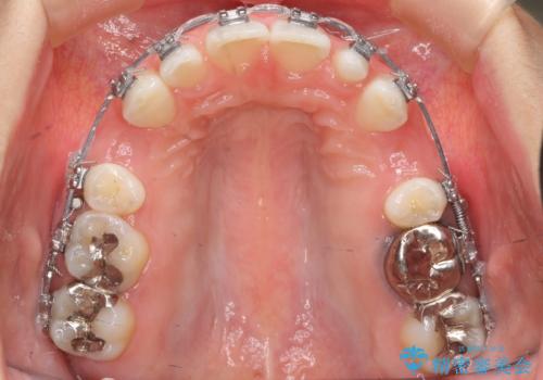 出っ歯を治したい 過蓋咬合の治療中