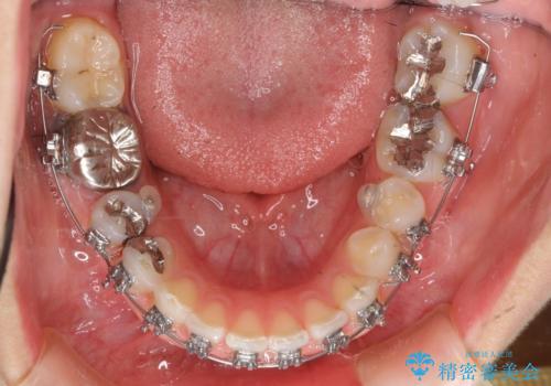 出っ歯を治したい 過蓋咬合の治療中
