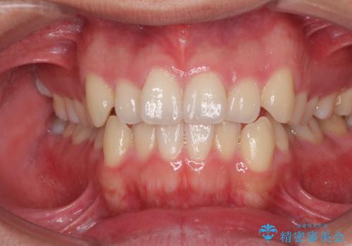 狭い歯列と前歯のデコボコ インビザラインによる矯正治療の症例 治療前