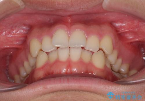 狭い歯列と前歯のデコボコ　インビザラインによる矯正治療の治療前