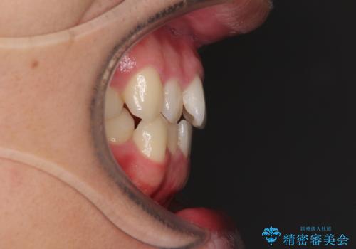 狭い歯列と前歯のデコボコ インビザラインによる矯正治療の治療前