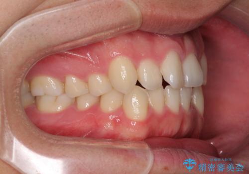 狭い歯列と前歯のデコボコ インビザラインによる矯正治療の治療前