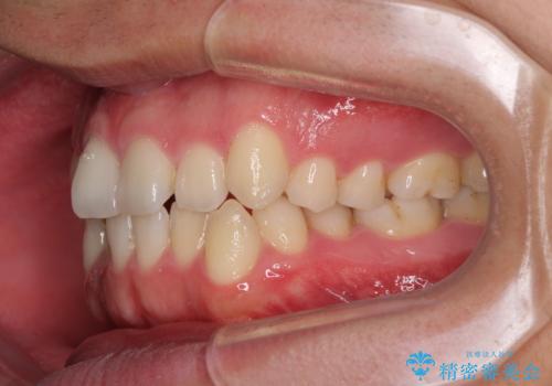 狭い歯列と前歯のデコボコ インビザラインによる矯正治療の治療前