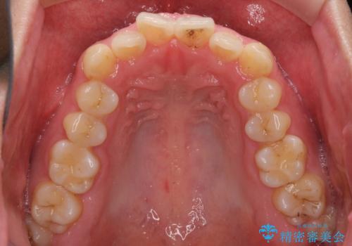 狭い歯列と前歯のデコボコ インビザラインによる矯正治療の治療前
