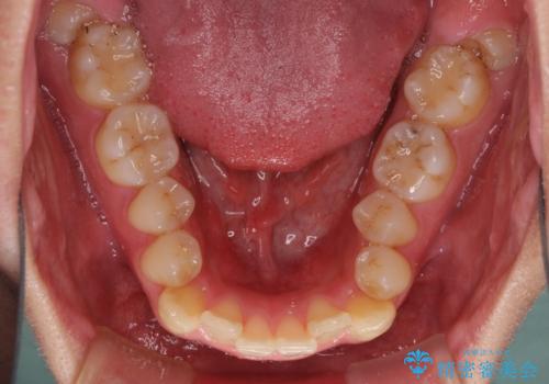 狭い歯列と前歯のデコボコ インビザラインによる矯正治療の治療前