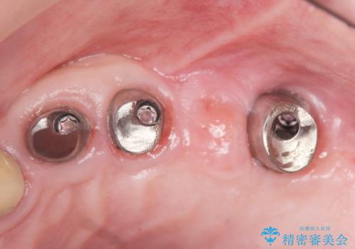他院でインプラントできないと言われた 上顎洞底挙上術を併用したインプラント 50代男性の治療後