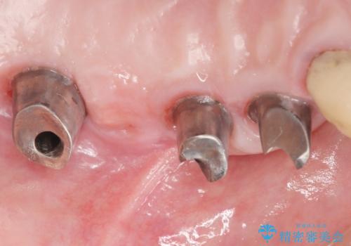 他院でインプラントできないと言われた 上顎洞底挙上術を併用したインプラント 50代男性の治療後