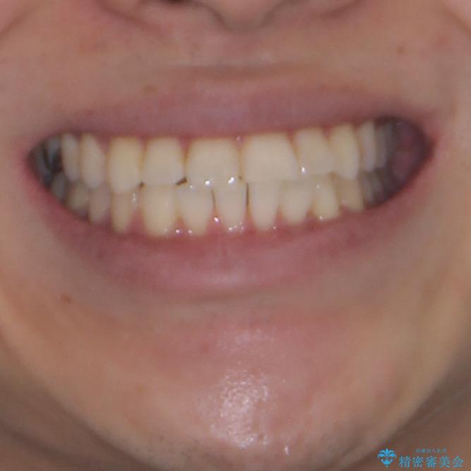 冷たいものがしみて奥歯が痛い 気になる歯並びも治したの治療後(顔貌)