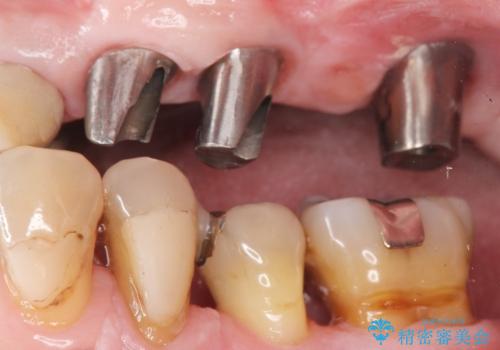 他院でインプラントできないと言われた 上顎洞底挙上術を併用したインプラント 50代男性の治療後