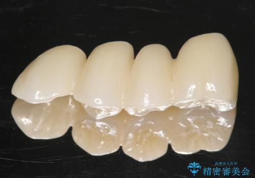 他院でインプラントできないと言われた 上顎洞底挙上術を併用したインプラント 50代男性の治療後