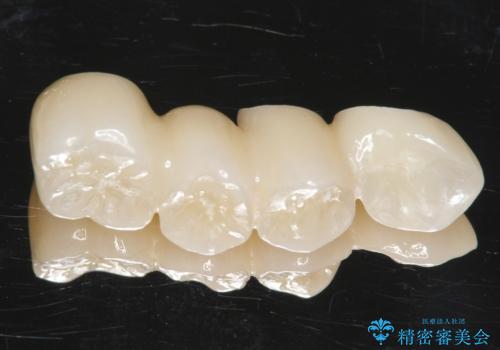 他院でインプラントできないと言われた 上顎洞底挙上術を併用したインプラント 50代男性の治療中