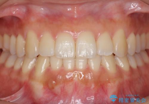 前歯のがたつき インビザラインで 下の奥歯を後ろに下げるの症例 治療後