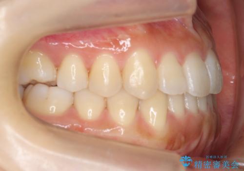 前歯のがたつき　インビザラインで　下の奥歯を後ろに下げるの治療後