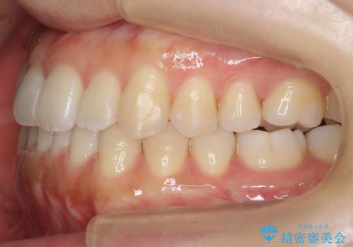 前歯のがたつき インビザラインで 下の奥歯を後ろに下げるの治療後