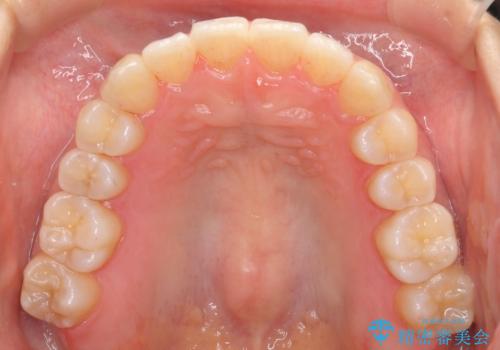 前歯のがたつき インビザラインで 下の奥歯を後ろに下げるの治療後