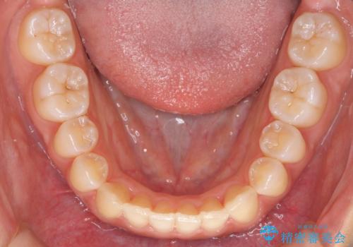 前歯のがたつき インビザラインで 下の奥歯を後ろに下げるの治療後