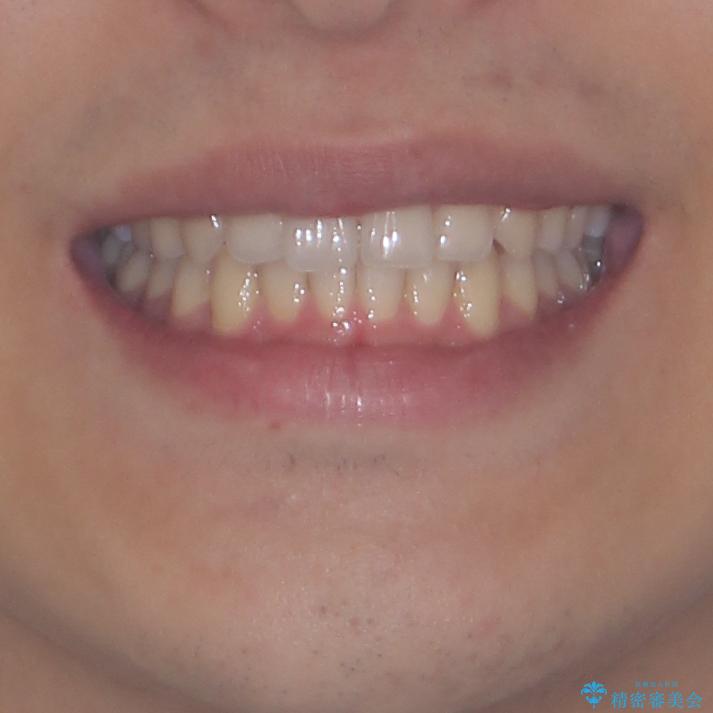 狭い歯列と前歯のデコボコ　インビザラインによる矯正治療の治療後（顔貌）