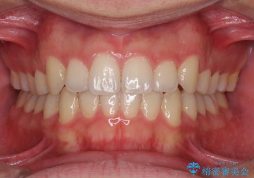 狭い歯列と前歯のデコボコ　インビザラインによる矯正治療