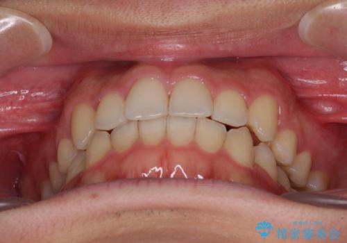 狭い歯列と前歯のデコボコ　インビザラインによる矯正治療の治療後