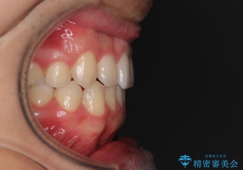 狭い歯列と前歯のデコボコ インビザラインによる矯正治療の治療後