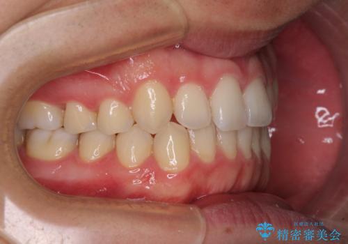 狭い歯列と前歯のデコボコ インビザラインによる矯正治療の治療後