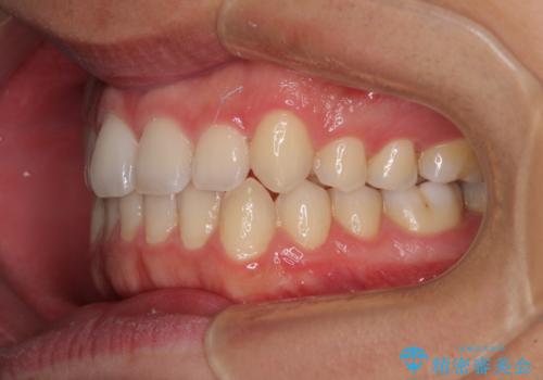 狭い歯列と前歯のデコボコ インビザラインによる矯正治療の治療後