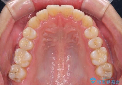 狭い歯列と前歯のデコボコ インビザラインによる矯正治療の治療後
