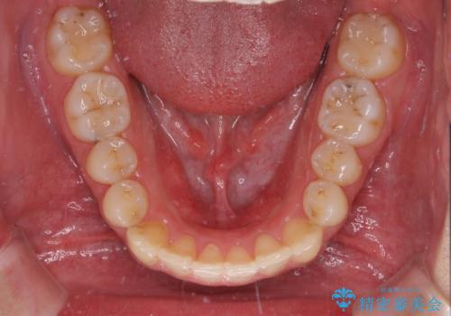 狭い歯列と前歯のデコボコ インビザラインによる矯正治療の治療後