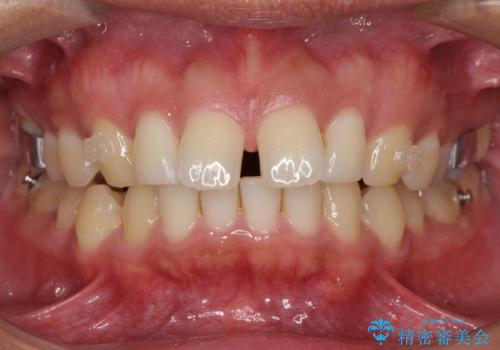 上顎の出っ歯とすきっ歯 補助装置を用いたインビザライン矯正の治療中