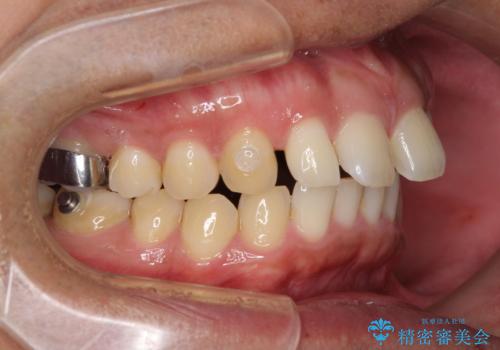上顎の出っ歯とすきっ歯　補助装置を用いたインビザライン矯正の治療中