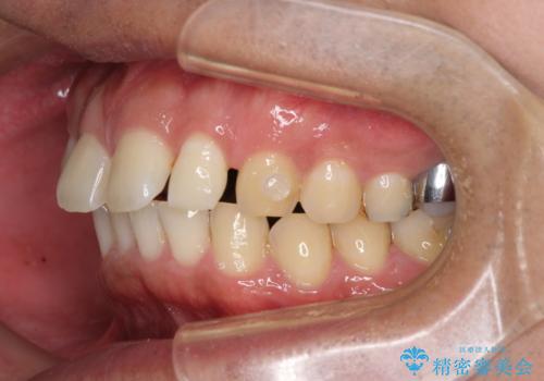 上顎の出っ歯とすきっ歯　補助装置を用いたインビザライン矯正の治療中