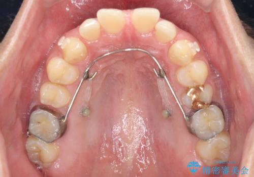 上顎の出っ歯とすきっ歯 補助装置を用いたインビザライン矯正の治療中