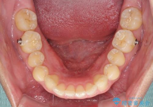 上顎の出っ歯とすきっ歯 補助装置を用いたインビザライン矯正の治療中