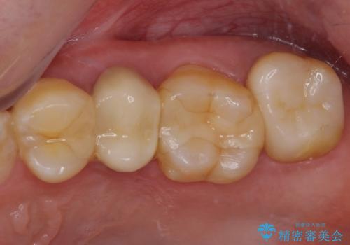 冷たいものがしみる 神経組織の一部を除去した虫歯治療の症例 治療後
