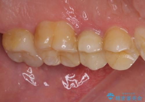 冷たいものがしみる 神経組織の一部を除去した虫歯治療の治療後