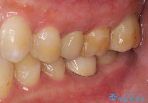 冷たいものがしみる 神経組織の一部を除去した虫歯治療の治療後