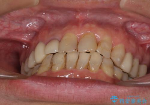 歯列不正と歯周病 総合歯科治療による全顎治療の治療中