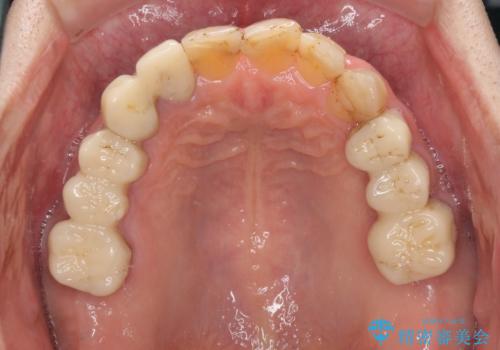 歯列不正と歯周病 総合歯科治療による全顎治療の治療中