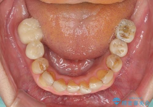 歯列不正と歯周病 総合歯科治療による全顎治療の治療中